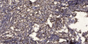 Immunohistochemical analysis of paraffin-embedded human Squamous cell carcinoma of lung. 1, Antibody was diluted at 1:200 (4°C overnight). 2, Tris-EDTA, pH9.0 was used for antigen retrieval. 3, Secondary antibody was diluted at 1:200 (room temperature, 45min).