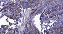 Immunohistochemical analysis of paraffin-embedded human Breast cancer. 1, Antibody was diluted at 1:200 (4°C overnight). 2, Tris-EDTA, pH9.0 was used for antigen retrieval. 3, Secondary antibody was diluted at 1:200 (room temperature, 45min).