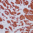 Formalin-fixed, paraffin-embedded human mesothelioma stained with anti-calretinin antibody using peroxidase-conjugate and DAB chromogen. Note cytoplasmic staining of mesothelioma cells