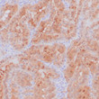 Anti-Galectin-3 antibody IHC human thyroid papillary carcinoma STJ180645