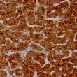 Anti-Glypican-3 antibody IHC Human hepatocellular carcinoma STJ180647