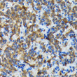 Immunohistochemistry analysis of paraffin-embedded human thyroid cancer using Thyroid Peroxidase Rabbit monoclonal antibody (STJ11103933) at dilution of 1:100 (40x lens). Perform microwave antigen retrieval with 10 mM Tris/EDTA buffer pH 9. 0 before commencing with immunohistochemistry staining protocol.