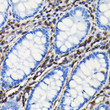 Immunohistochemistry analysis of Vimentin in paraffin-embedded human colon using Vimentin Rabbit polyclonal antibody (STJ11104460) at dilution of 1:100 (40x lens). Perform high pressure antigen retrieval with 10 mM citrate buffer pH 6. 0 before commencing with immunohistochemistry staining protocol.