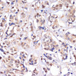 Immunohistochemistry analysis of paraffin-embedded human breast cancer using MST1/STK4 antibody (STJ11104582) at dilution of 1:100 (40x lens). Perform microwave antigen retrieval with 10 mM PBS buffer pH 7. 2 before commencing with immunohistochemistry staining protocol.