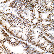 Immunohistochemistry analysis of Cyclin E1 in paraffin-embedded human colon carcinoma using Cyclin E1 Rabbit monoclonal antibody (STJ11104815) at dilution of 1:100 (40x lens). Perform high pressure antigen retrieval with 10 mM citrate buffer pH 6. 0 before commencing with immunohistochemistry staining protocol.