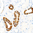 Immunohistochemistry analysis of paraffin-embedded human kidney using Cytokeratin 19 (KRT19) Rabbit monoclonal antibody (STJ11104838) at dilution of 1:100 (40x lens). Perform microwave antigen retrieval with 10 mM PBS buffer pH 7. 2 before commencing with immunohistochemistry staining protocol.