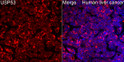 Immunofluorescence analysis of paraffin-embedded Human liver cancer using USP53 Rabbit polyclonal antibody (STJ11105514) at a dilution of 1:150 (40x lens). Secondary antibody:Cy3 Goat Anti-Rabbit IgG (H+L) at 1:500 dilution. Blue: DAPI for nuclear staining. Perform high pressure antigen retrieval with 0. 01 M citrate buffer (pH 6. 0) prior to IF staining.