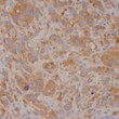 Formalin-fixed, paraffin-embedded human melanoma stained with anti-BRAF (V600E) antibody using peroxidase-conjugate and DAB chromogen. Note cytoplasmic staining of tumor cells with V600E mutation Formalin-fixed, paraffin-embedded human melanoma stained with anti-BRAF (V600E) antibody using peroxidase-conjugate and DAB chromogen. Note cytoplasmic staining of tumor cells with V600E mutation
