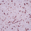 Formalin-fixed, paraffin-embedded CMV infected tissue stained with anti-CMV antibody using peroxidase-conjugate and DAB chromogen. Note the large stromal cells are positive with a cytoplasmic and nuclear staining. Formalin-fixed, paraffin-embedded CMV infected tissue stained with anti-CMV antibody using peroxidase-conjugate and DAB chromogen. Note the large stromal cells are positive with a cytoplasmic and nuclear staining.