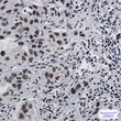 Immunohistochemistry analysis of paraffin-embedded Human lung cancer using DDX5 antibody. High-pressure and temperature Sodium Citrate pH 6. 0 was used for antigen retrieval.