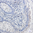 Immunohistochemistry analysis of paraffin-embedded Human colon cancer using Galactosidase alpha antibody. High-pressure and temperature Sodium Citrate pH 6. 0 was used for antigen retrieval.