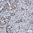 Immunohistochemistry analysis of paraffin-embedded Human lung cancer using SEC61A antibody. High-pressure and temperature Sodium Citrate pH 6. 0 was used for antigen retrieval.