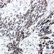 Immunohistochemistry analysis of paraffin-embedded Human Cholangiocarcinoma using TCF4 antibody. High-pressure and temperature Sodium Citrate pH 6. 0 was used for antigen retrieval.
