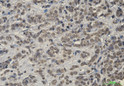 Immunohistochemistry analysis of paraffin-embedded Human breast cancer using Keap1 antibody. High-pressure and temperature Sodium Citrate pH 6. 0 was used for antigen retrieval.