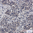 Immunohistochemistry analysis of paraffin-embedded Human lung cancer using SFT antibody. High-pressure and temperature Sodium Citrate pH 6. 0 was used for antigen retrieval.
