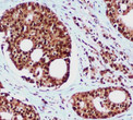 Immunohistochemistry analysis of paraffin-embedded Prostate Cancer using hHR23b antibody. High-pressure and temperature Sodium Citrate pH 6. 0 was used for antigen retrieval.