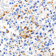 Immunohistochemistry analysis of CD68. Sample: Human renal cancer, 4% PFA 12-24h. Antigen retrieval: Citrate buffer, pressure cooker 2 min. Primary antibody: 1:1000, 4C overnight. Secondary antibody: S-vision poly-HRP conjugated Goat Anti-mouse lgG, Ready to use, RT, 20min.