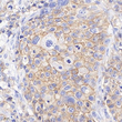 Immunohistochemistry analysis of paraffin embedded human breast cancer using ERBB2 at dilution of 1:1000