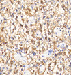 Immunohistochemistry analysis of paraffin embedded human glioblastoma multiforme using GFAP at dilution of 1:500 Immunohistochemistry analysis of paraffin embedded human glioblastoma multiforme using GFAP at dilution of 1:500