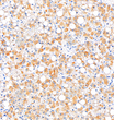 Immunohistochemistry analysis of Transferrin. Sample: Human liver cancer, 4% PFA 12-24h. Antigen retrieval: Citrate buffer, pressure cooker 2 min. Primary antibody: 1:1000, 4C overnight. Secondary antibody: S-vision poly-HRP conjugated Goat Anti-Rabbit lgG, Ready to use, RT, 20min.