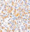 Immunohistochemistry analysis of Transferrin. Sample: Human liver cancer, 4% PFA 12-24h. Antigen retrieval: Citrate buffer, pressure cooker 2 min. Primary antibody: 1:1000, 4C overnight. Secondary antibody: S-vision poly-HRP conjugated Goat Anti-Rabbit lgG, Ready to use, RT, 20min.