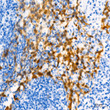 Immunohistochemistry analysis of paraffin-embedded Human cervix cancer using CDKN2A/p16INK4a Mouse mAb (STJ11106646) at dilution of 1:50 (40x lens). High pressure antigen retrieval performed with 0. 01M Tris/EDTA Buffer (pH 9. 0) prior to immunohistochemistry staining. Immunohistochemistry analysis of paraffin-embedded Human cervix cancer using CDKN2A/p16INK4a Mouse mAb (STJ11106646) at dilution of 1:50 (40x lens). High pressure antigen retrieval performed with 0. 01M Tris/EDTA Buffer (pH 9. 0) prior to immunohistochemistry staining.