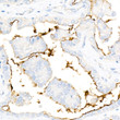 Immunohistochemistry analysis of paraffin-embedded Human thyroid cancer tissue using ICAM-1/CD54 Rabbit mAb (STJ11106969) at a dilution of 1:400 (40x lens). High pressure antigen retrieval performed with 0. 01M Citrate Bufferr (pH 6. 0) prior to immunohistochemistry staining.