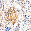 Immunohistochemistry analysis of paraffin-embedded Human cervical squamous cell carcinoma tissue using [KD Validated] MRPL27 Rabbit pAb  (STJ11107034) at a dilution of 1:100 (40x lens).  High pressure antigen retrieval was performed with 0. 01 M citrate buffer (pH 6. 0) prior to immunohistochemistry staining.