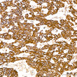 Immunohistochemistry analysis of SGPL1 in paraffin-embedded Human lung cancer tissue using SGPL1 Rabbit pAb (STJ11107092) at a dilution of 1:200 (40x lens). High pressure antigen retrieval performed with 0. 01M Citrate Buffer (pH 6. 0) prior to immunohistochemistry staining.