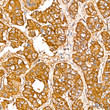 Immunohistochemistry analysis of SGPL1 in paraffin-embedded Human liver cancer tissue using SGPL1 Rabbit pAb (STJ11107092) at a dilution of 1:200 (40x lens). High pressure antigen retrieval performed with 0. 01M Citrate Buffer (pH 6. 0) prior to immunohistochemistry staining.