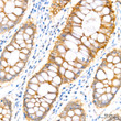 Immunohistochemistry analysis of paraffin-embedded Human colon carcinoma tissue using PER1 Rabbit mAb (STJ11107329) at a dilution of 1:300 (40x lens). High pressure antigen retrieval performed with 0. 01M Citrate Buffer (pH 6. 0) prior to immunohistochemistry staining.
