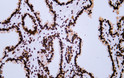 Immunohistochemistry - Paraffin (IHC-P): Human prostate tissue was stained with anti-AR (ABT101) antibody. STJA0038900