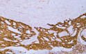 Immunohistochemistry - Paraffin (IHC-P): Human colon carcinoma tissue was stained with anti-beta-catenin (ABT-Catenin) STJA0038901