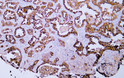 Immunohistochemistry - Paraffin (IHC-P): Human lung adenocarcinoma tissue was stained with Anti-MUC1 (ABT100) antibody. STJA0038905