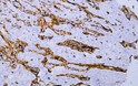Immunohistochemistry - Paraffin (IHC-P): Human esophageal squamous cell carcinoma tissue was stained with Anti-Vimentin STJA0038923