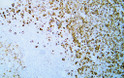 Immunohistochemistry (IHC): Human malignant melanoma tissue was stained with Anti-CD63 (ABT420) antibody. STJA0038946