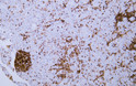 Immunohistochemistry - Paraffin (IHC-P): Human hepatocellular carcinoma tissue was stained with anti-CD45 (ABT-CD45) STJA0038966