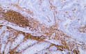 Immunohistochemistry - Paraffin (IHC-P): Human rectal carcinoma tissue was stained with Anti-CD45 (ABT-CD45) antibody. STJA0038966