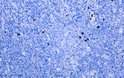 Immunohistochemistry - Paraffin (IHC-P): Human Burkitt lymphoma tissue was stained with Anti-CD8 (ABT155) Antibody STJA0038974