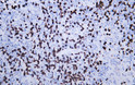 Immunohistochemistry - Paraffin (IHC-P): Human lymphoma tissue was stained with Anti-CD8 (ABT155) Antibody. STJA0038974