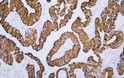 Immunohistochemistry - Paraffin (IHC-P): Human colon carcinoma tissue was stained with anti-Cytokeratin 8/18 STJA0038981