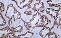 Immunohistochemistry - Paraffin (IHC-P): Human lung adenocarcinoma tissue was stained with anti-Cytokeratin 8/18 STJA0038981