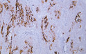 Immunohistochemistry - Paraffin (IHC-P): Human cervical squamous cell carcinoma tissue was stained with STJA0038984