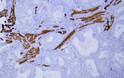 Immunohistochemistry - Paraffin (IHC-P): Human endometrial adenocarcinoma tissue was stained with Anti-Desmin (ABT168) STJA0038993