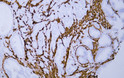Immunohistochemistry - Paraffin (IHC-P): Human prostatic adenocarcinoma tissue was stained with Anti-Desmin (ABT168) STJA0038993