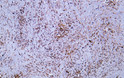 Immunohistochemistry - Paraffin (IHC-P): Human schwannoma tissue was stained with Anti-Factor XIIIa (ABT170) Antibody. STJA0038999