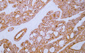 Immunohistochemistry - Paraffin (IHC-P): Human colon carcinoma tissue was stained with Anti-HSP60 (ABT186) Antibody. STJA0039008