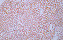 Immunohistochemistry - Paraffin (IHC-P): Human hepatocellular carcinoma tissue was stained with Anti-HSP60 (ABT186) STJA0039008
