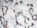 Immunohistochemistry - Paraffin (IHC-P): Human breast carcinoma tissue was stained with Anti-p63 (ABT-P63) antibody. STJA0039021
