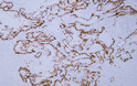 Immunohistochemistry (IHC): Human colon carcinoma tissue was stained with Anti-SOX9 (ABT-SOX9) antibody. STJA0039027